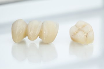 Zahn und Zahnbrücke aus dem Labor